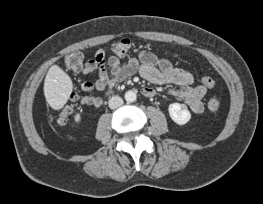 Tuberous Sclerosis with Lung Cysts and Incidental Renal Cell Carcinoma - CTisus CT Scan