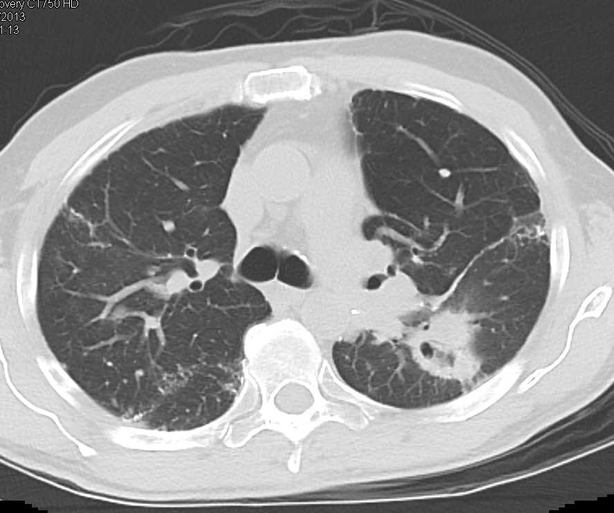 Bronchoalveolar Cell Carcinoma Left Upper Lung - CTisus CT Scan