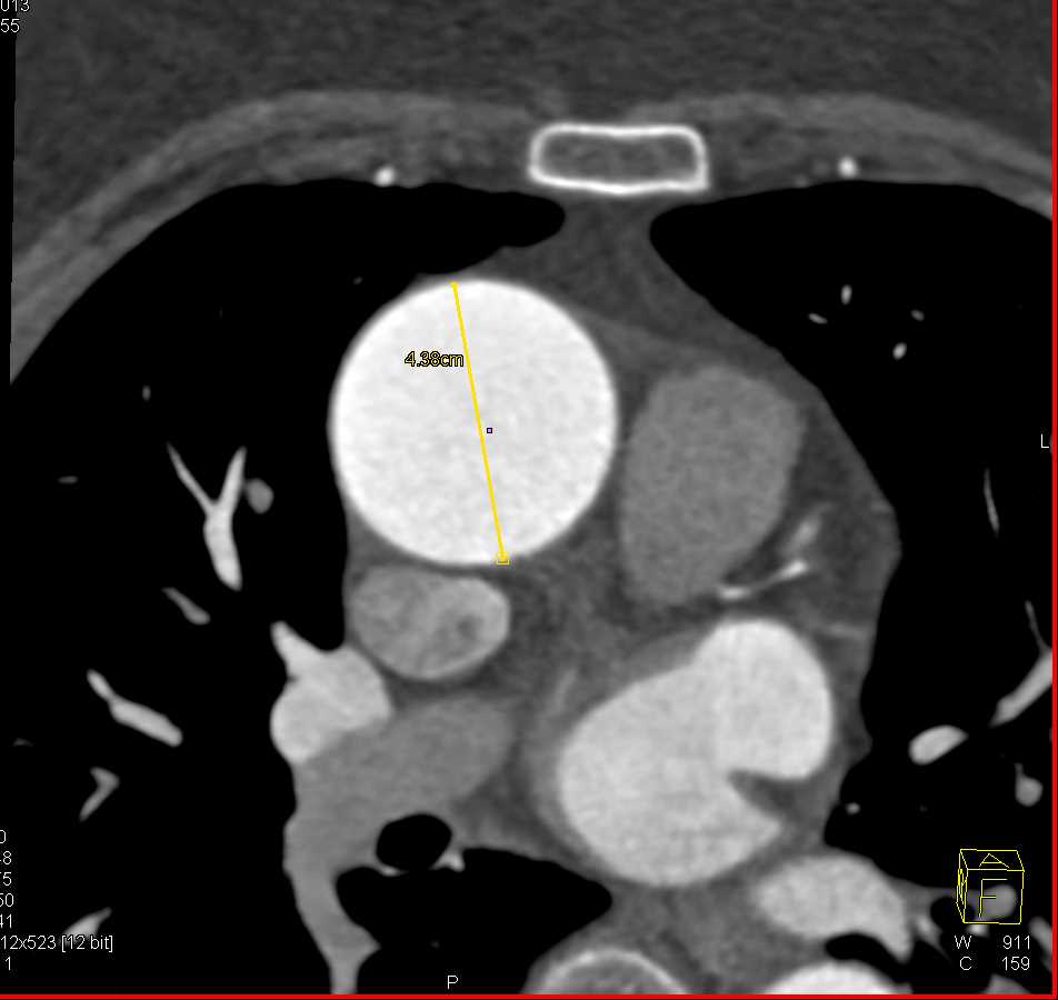 Dilated Ascending Aorta - Chest Case Studies - CTisus CT Scanning