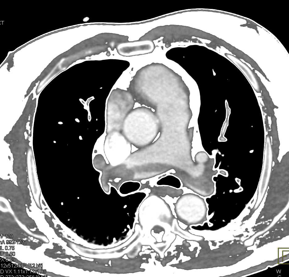 Extensive Pulmonary Embolism - CTisus CT Scan
