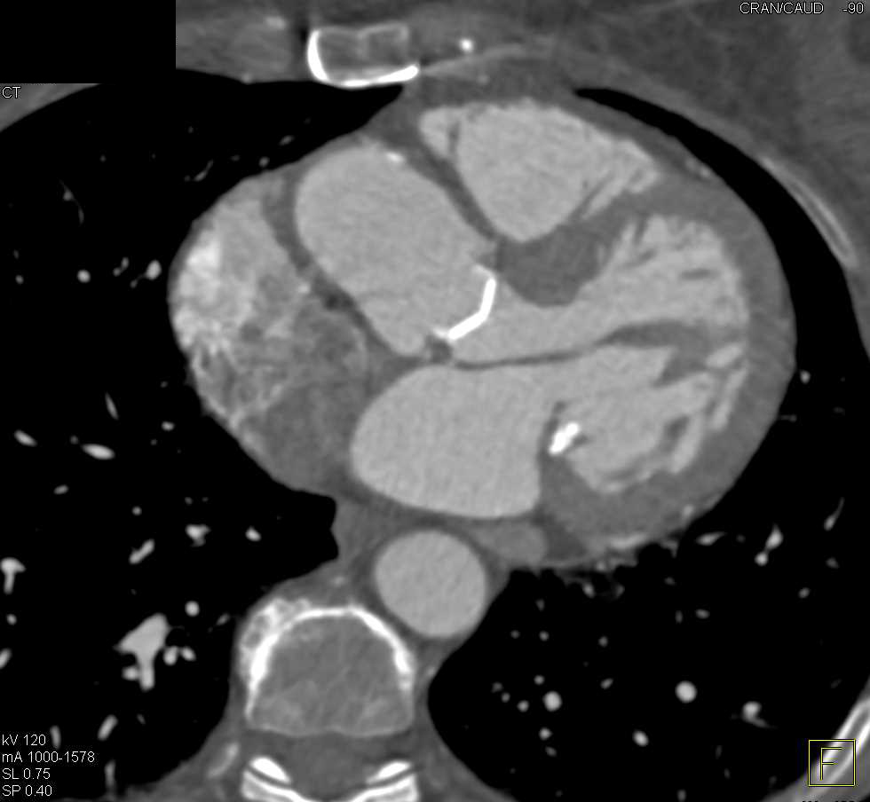 Aortic Valve Replacement With Dilated Ascending Aorta - CTisus CT Scan