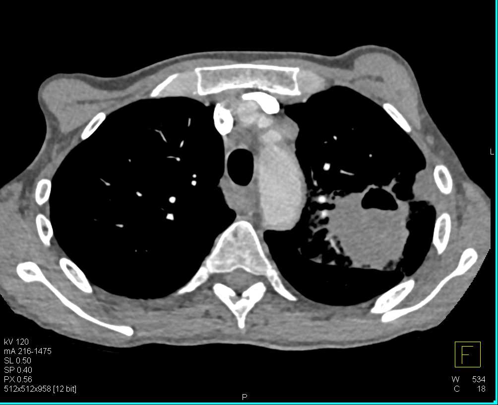 Cavitary Squammous Cell Carcinoma with Adenopathy in Left Upper Lung - CTisus CT Scan