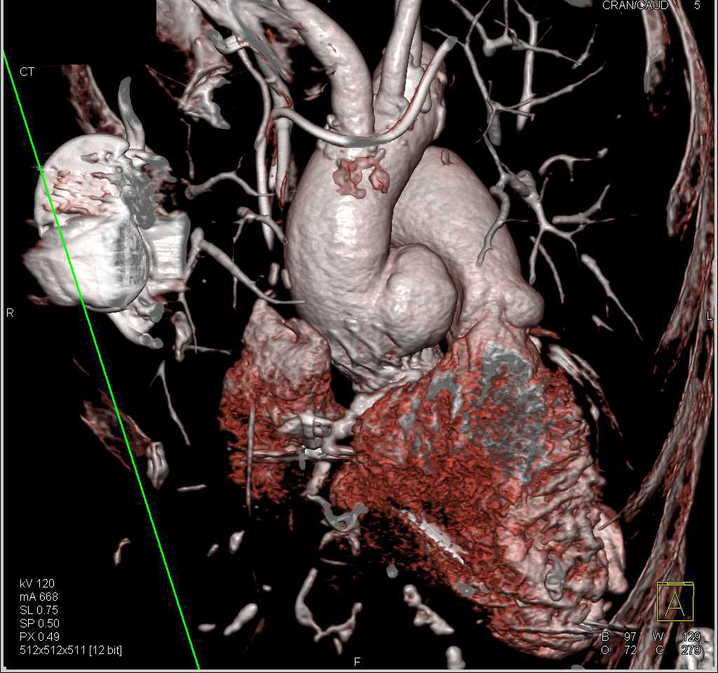 Pseudoaneurysm of the Aortic Root Following Aortic Valve Replacement (AVR) - CTisus CT Scan