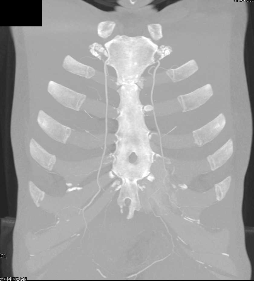 Prior Embolization of Pulmonary Arteriovenous Malformation (PAVM) - CTisus CT Scan