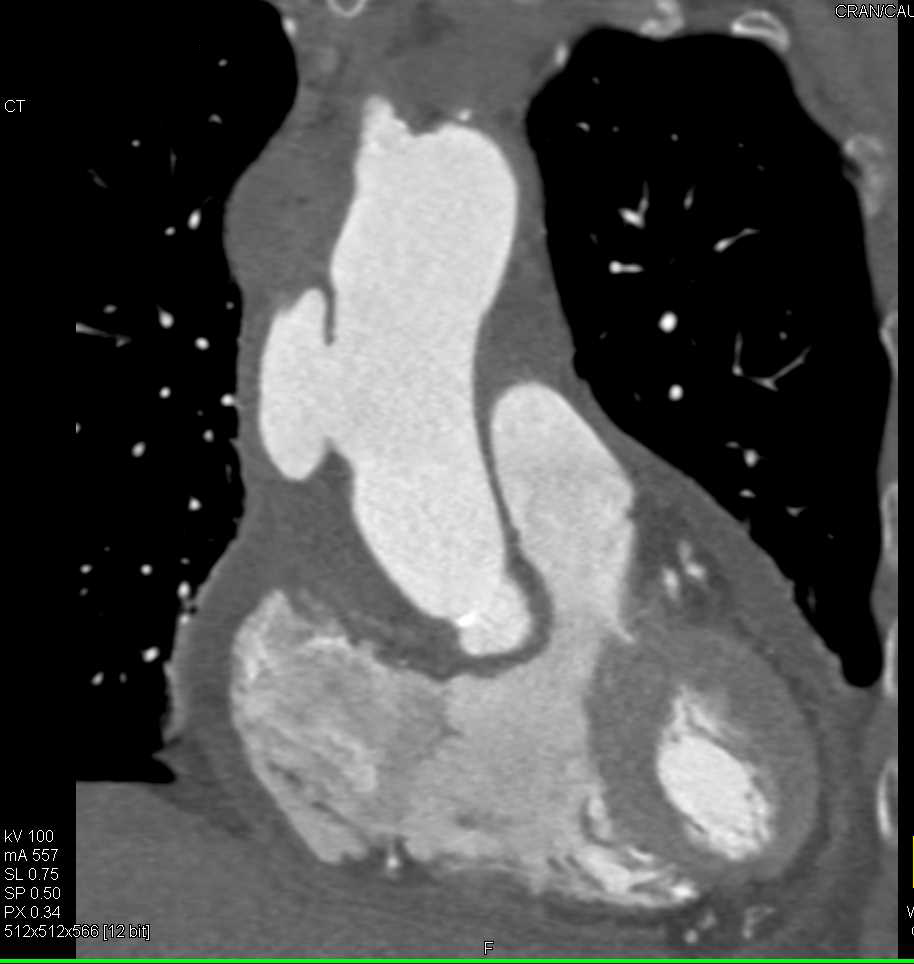 Focal Dissection Ascending Aorta - CTisus CT Scan