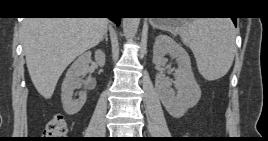 Tuberous Sclerosis with Lung Cysts and Incidental Renal Cell Carcinoma - CTisus CT Scan