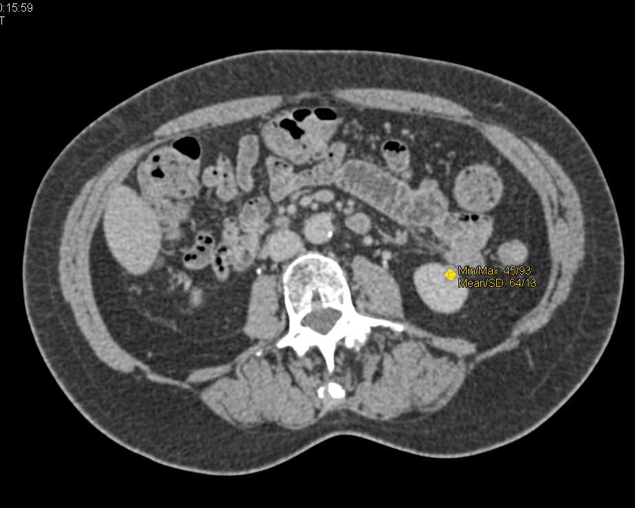 Multiple Lungs Cysts in Tuberous Sclerosis - CTisus CT Scan