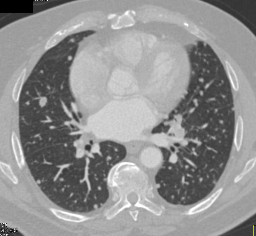 Miliary Lung Metastases - CTisus CT Scan