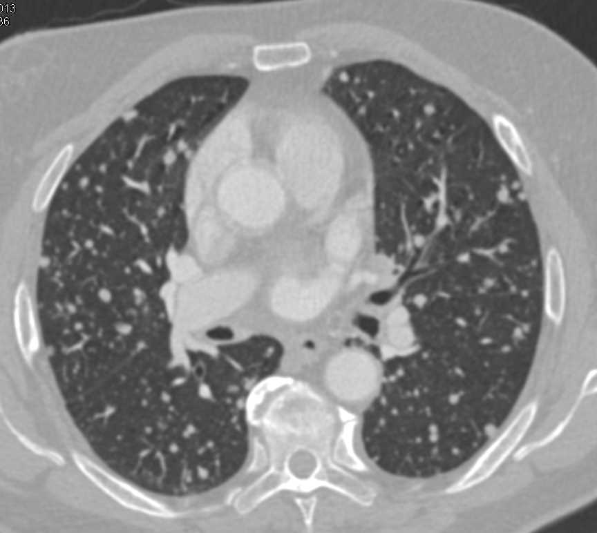 Miliary Lung Metastases from Thyroid Cancer - CTisus CT Scan