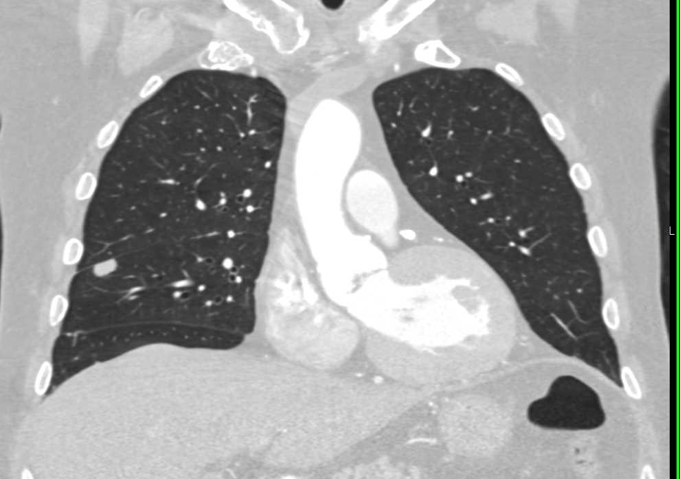 Pseudo-Nodule Against the Fissure - CTisus CT Scan