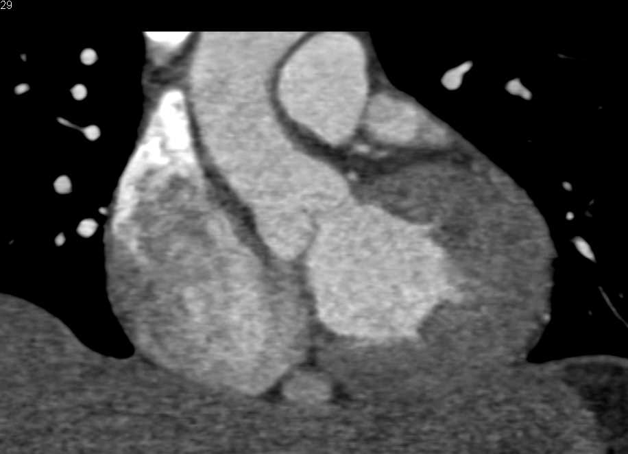 Vascular Map for Tracking Injection Timing - CTisus CT Scan