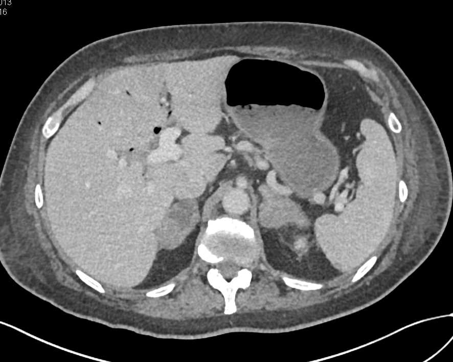 Carcinoma Left Upper Lung with Left Adrenal Metastases - Chest Case ...