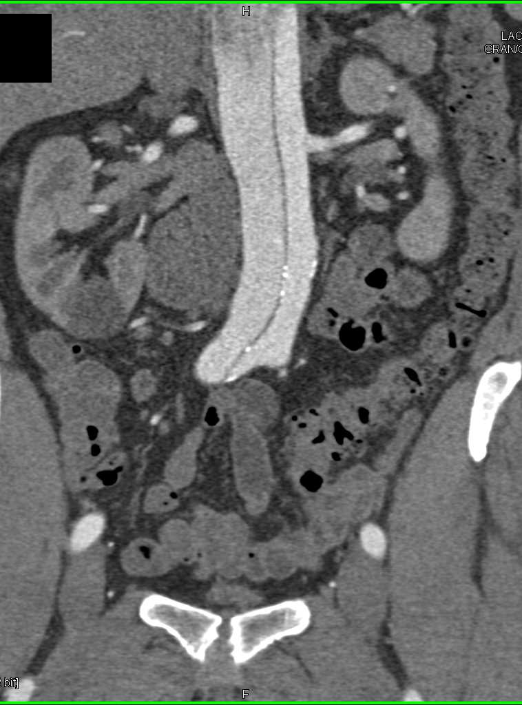 Type A Dissection with Compromised True Lumen in Thoracic Aorta - CTisus CT Scan