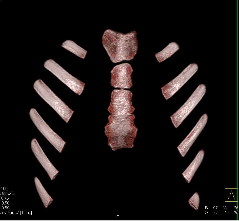 Pectus Deformity in 3D - CTisus CT Scan