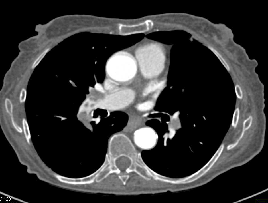 Multiple Pulmonary Emboli and Renal Infarcts - CTisus CT Scan