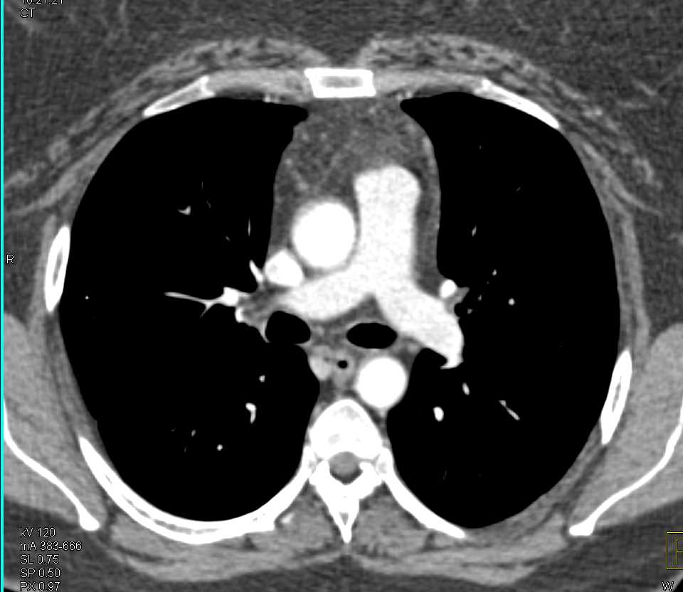 Fatty Infiltration of the Thymus Gland - Chest Case Studies - CTisus CT