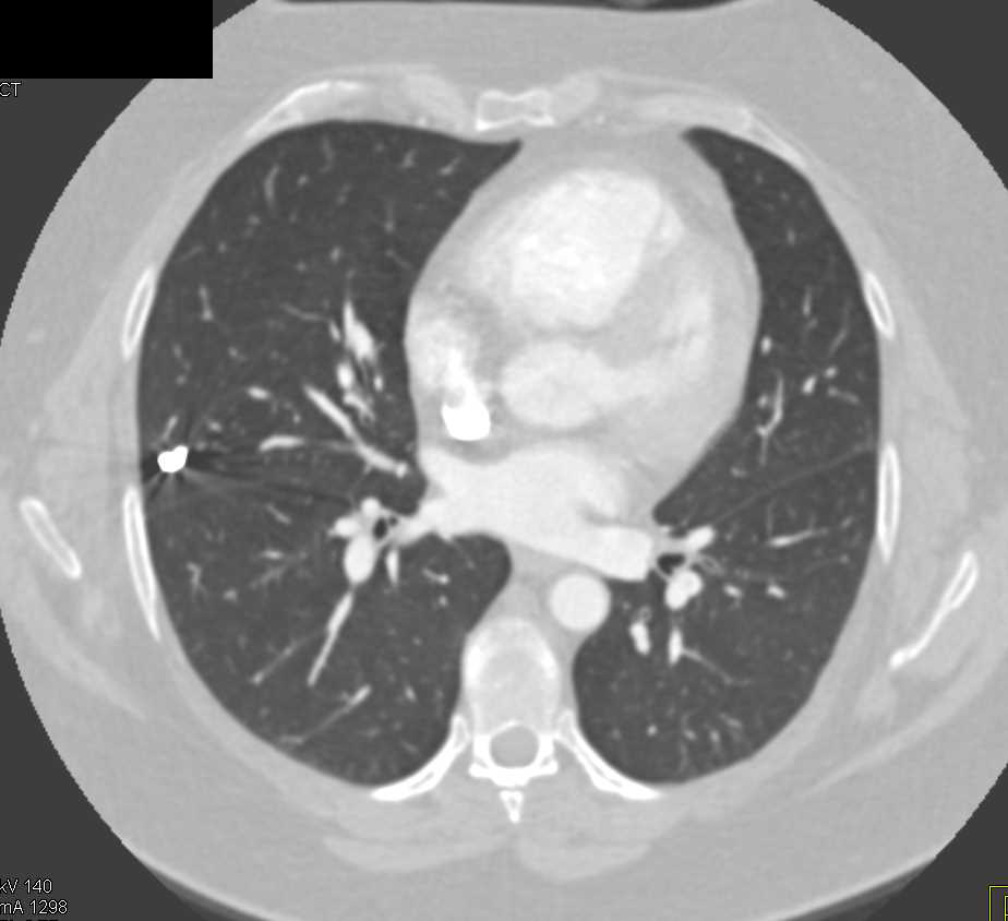 Left Lower Lung Pulmonary Arteriovenous Malformation (PAVM) with Areas of Prior Coiling - CTisus CT Scan