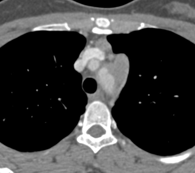 Thymoma Invades the Pulmonary Artery - Chest Case Studies - CTisus CT ...