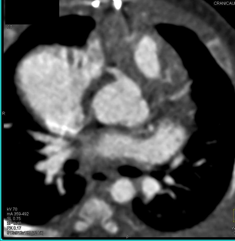 Repair with Narrow Main Pulmonary Artery Outflow Track - CTisus CT Scan