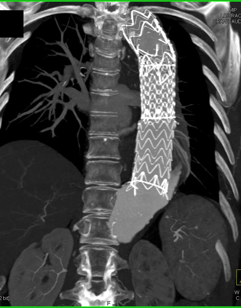 Endovascular Stent in Thoracic Aorta - Chest Case Studies - CTisus CT
