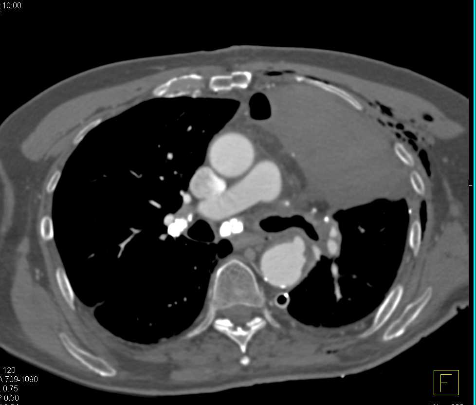 Left Upper Lobe Collapse with Encasement of the Left Pulmonary Artery - CTisus CT Scan