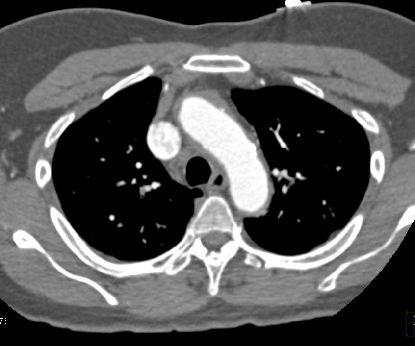 Multiple Ulcerations in the Thoracic Aorta - CTisus CT Scan