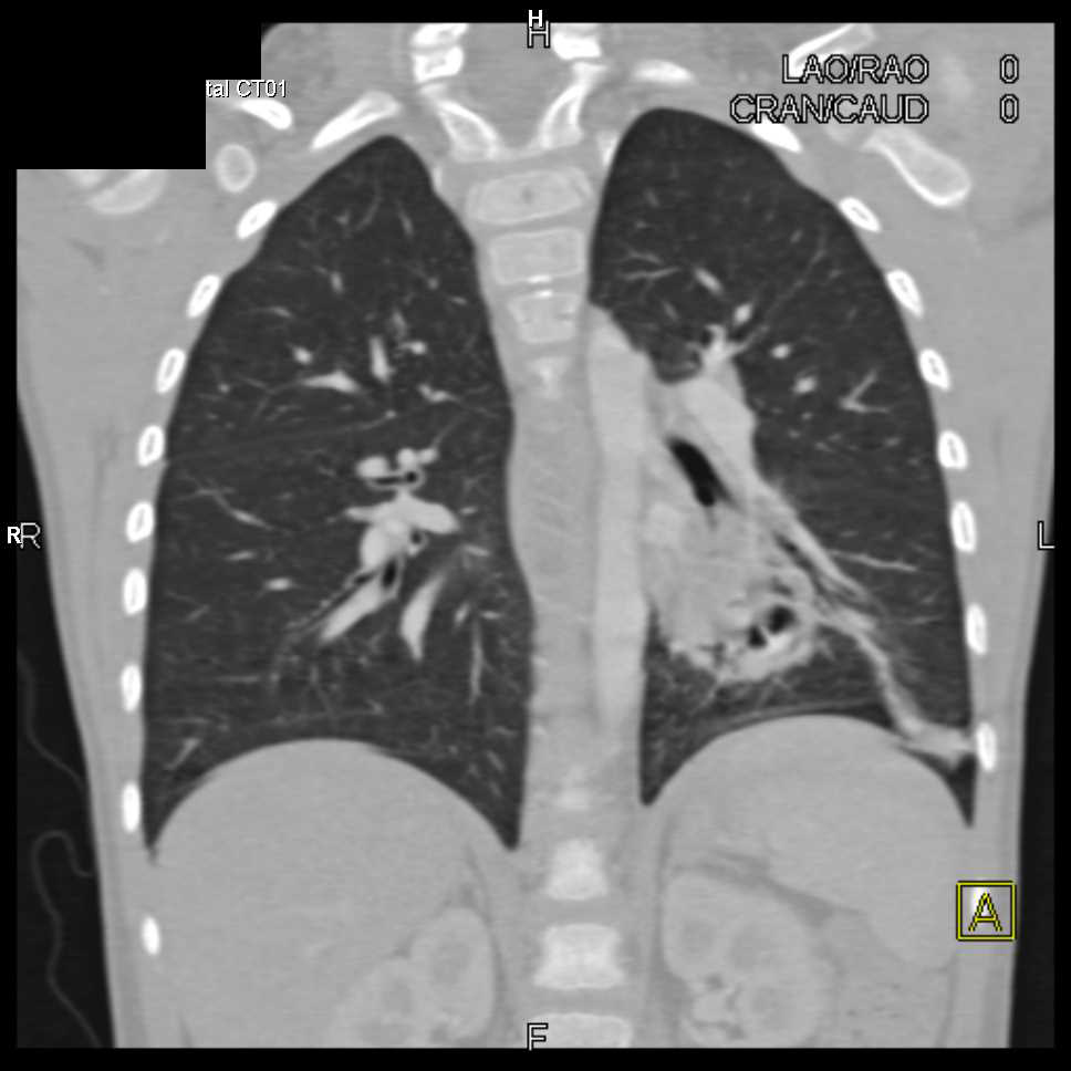 Sequestration Left Lower Lobe - CTisus CT Scan