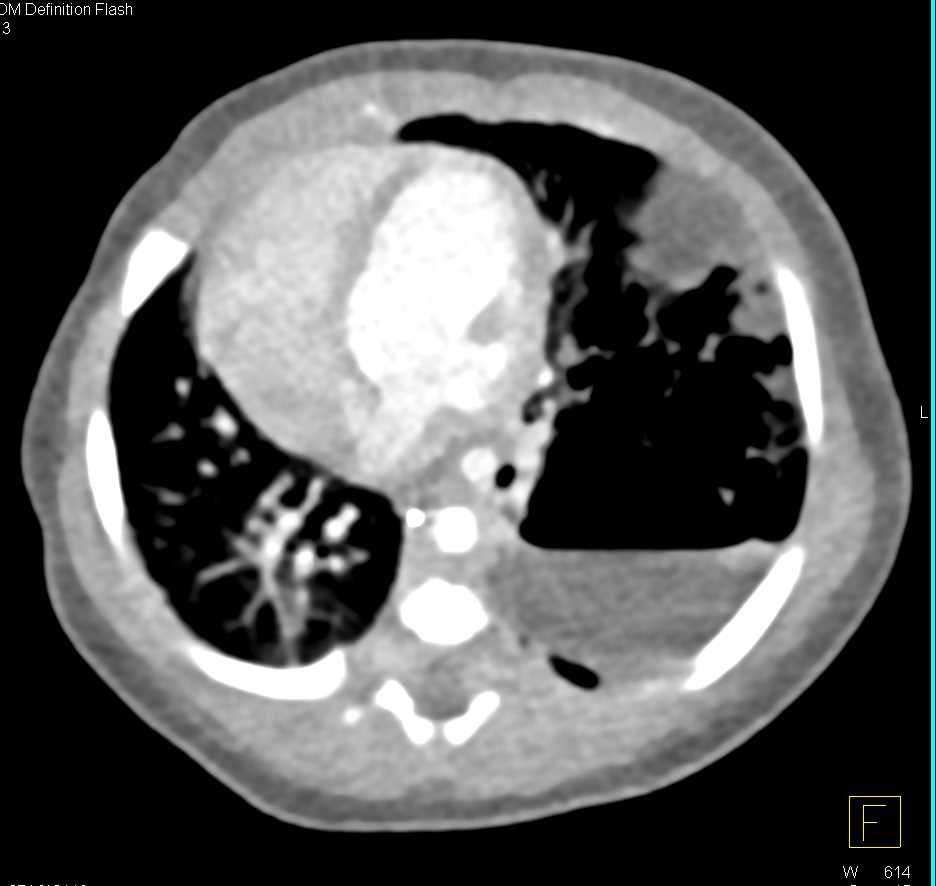 Cystic Adenomatoid Malformation Left Lung with Abscess - CTisus CT Scan