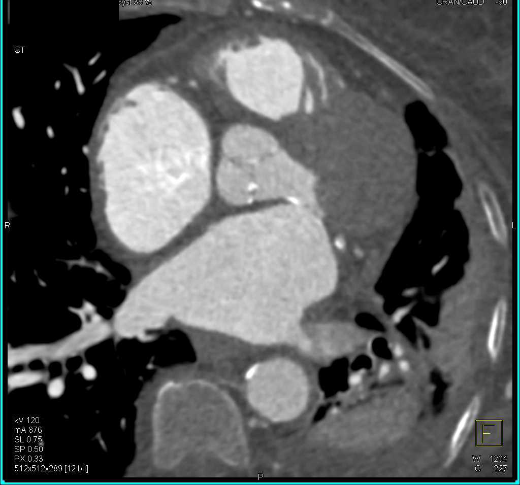 Aortic Valvular Calcifications - CTisus CT Scan