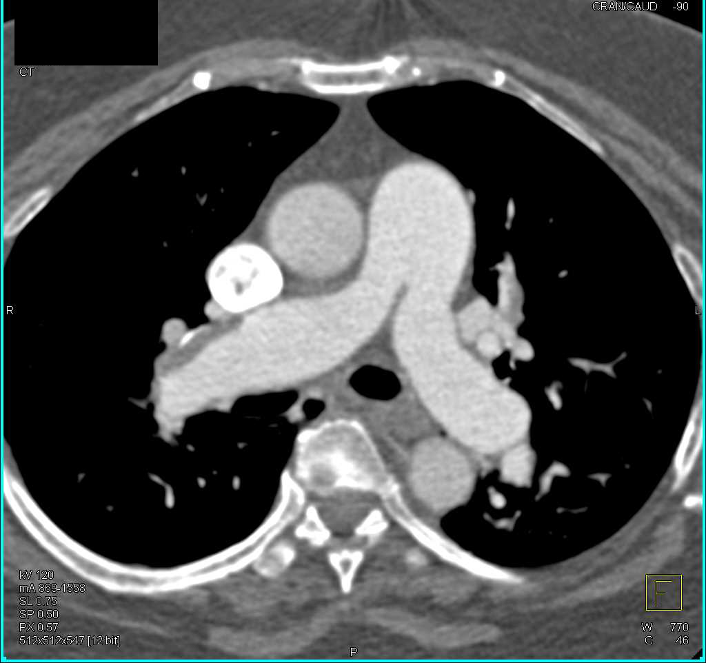 Pulmonary Embolism - CTisus CT Scan