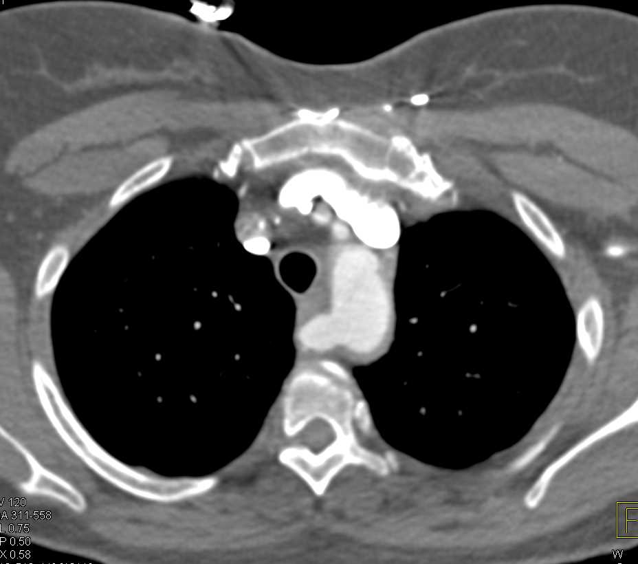 Aberrant Right Subclavian Artery - CTisus CT Scan