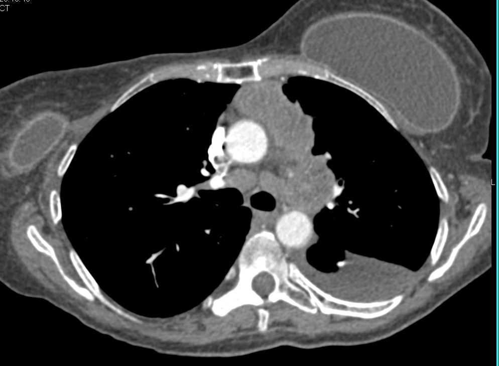 Lymphoma with Splenic and Hepatic Involvement - CTisus CT Scan