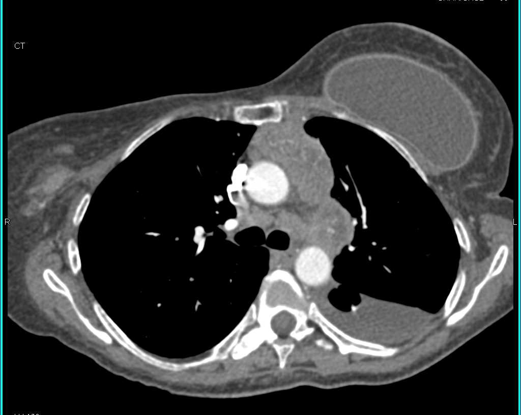 Metastatic Breast Cancer to Mediastinum and Spleen and Liver - CTisus CT Scan