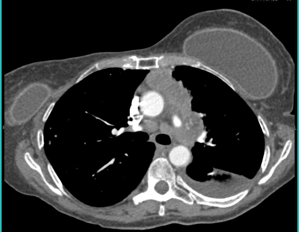 Metastatic Breast Cancer to Mediastinum and Spleen and Liver - CTisus CT Scan