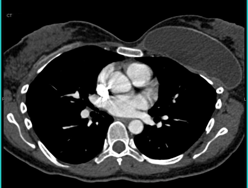 Failed Right Breast Implant - CTisus CT Scan