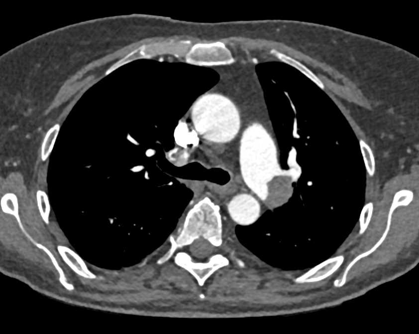 Bilateral Pulmonary Embolism - CTisus CT Scan