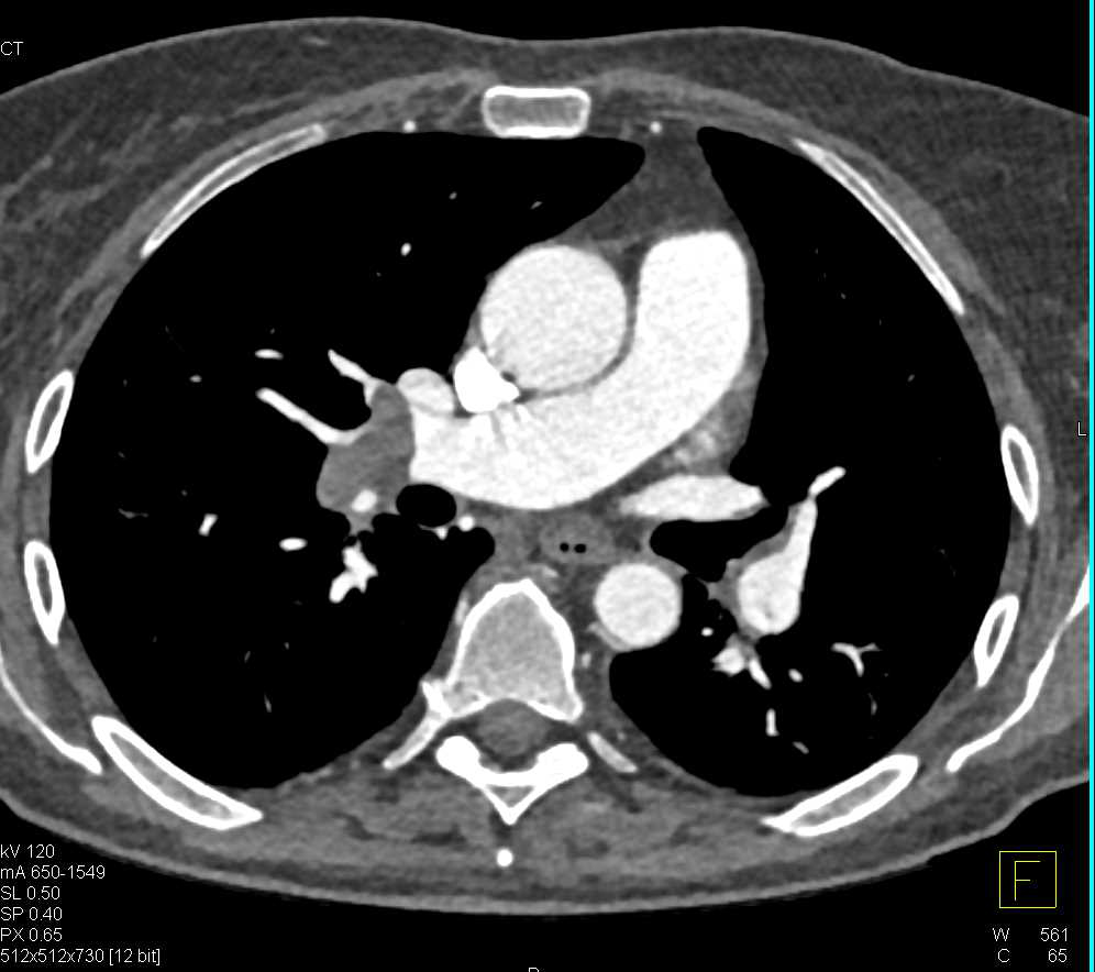 Bilateral Pulmonary Embolism - CTisus CT Scan