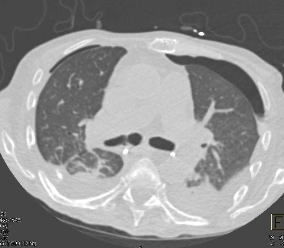 Bilateral Pneumothorax - CTisus CT Scan