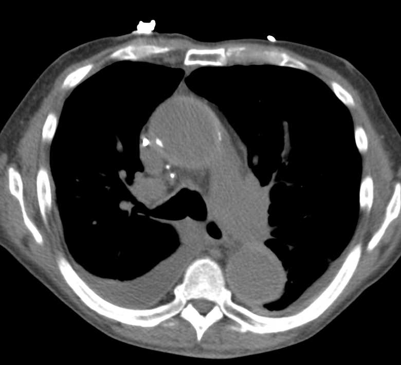 Intramural Hematoma of the Ascending and Descending Aorta - CTisus CT Scan