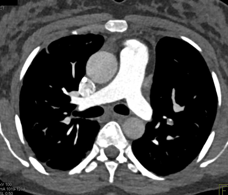 Pulmonary Embolism - CTisus CT Scan