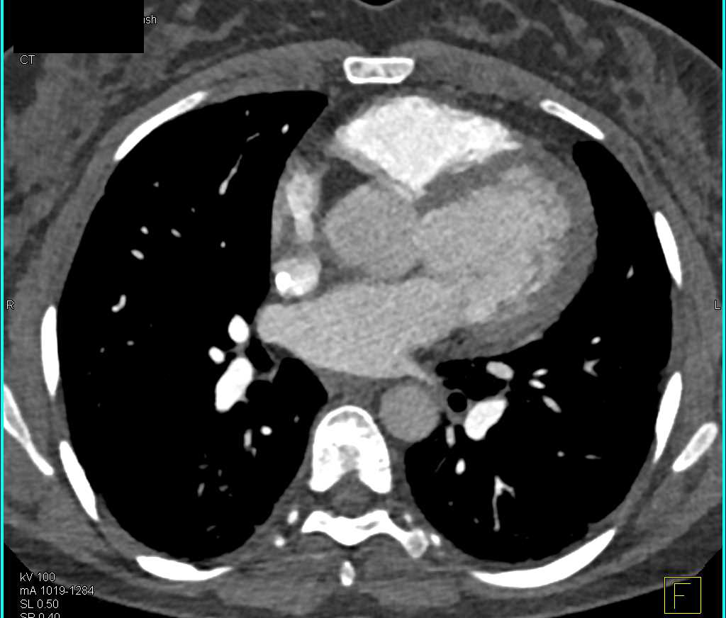 Bilateral Pulmonary Emboli Best Seen on Coronal Views - CTisus CT Scan