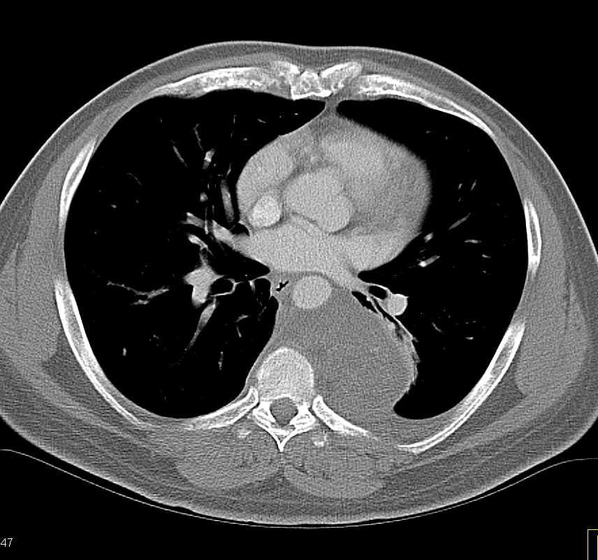 Neurogenic Sarcoma - CTisus CT Scan