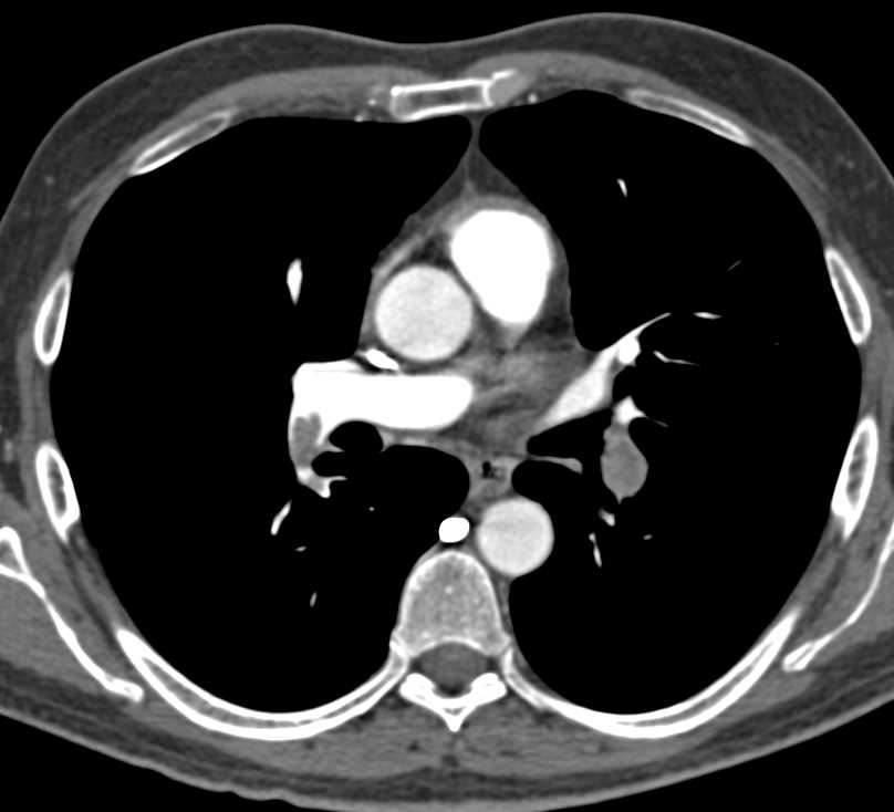 Incidental Pulmonary Embolism in Right Lung with Spread of Tumor in Pancreatic Cancer - CTisus CT Scan