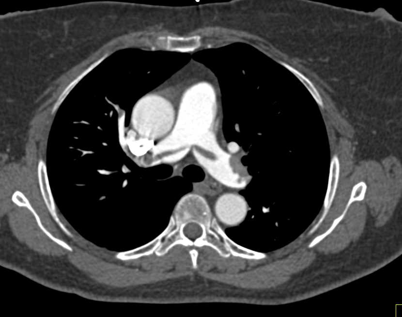 Extensive Pulmonary Embolism with Saddle Embolism - CTisus CT Scan