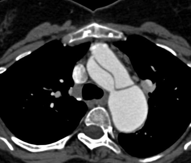 Type A Dissection with Repair and Descending Aorta Dissection - CTisus CT Scan