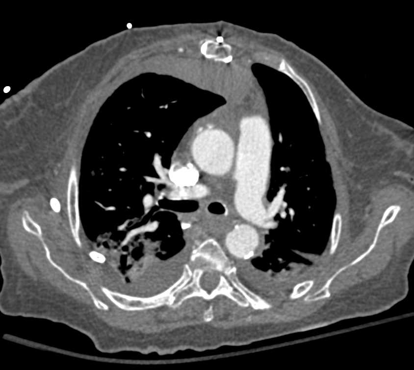 Empyema in Post Operative Patient - CTisus CT Scan