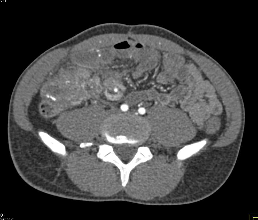 Lung Cancer with Abdominal Metastases - CTisus CT Scan