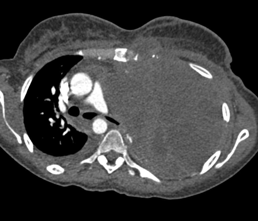 Lung Cancer Invades the Heart and Pleura with Substantial Mass Effect - CTisus CT Scan