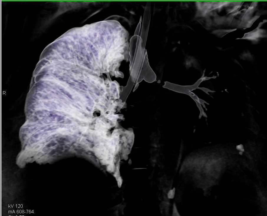 Endotracheal Tube in Right Mainstem Bronchus and Mucoid Impaction in ...