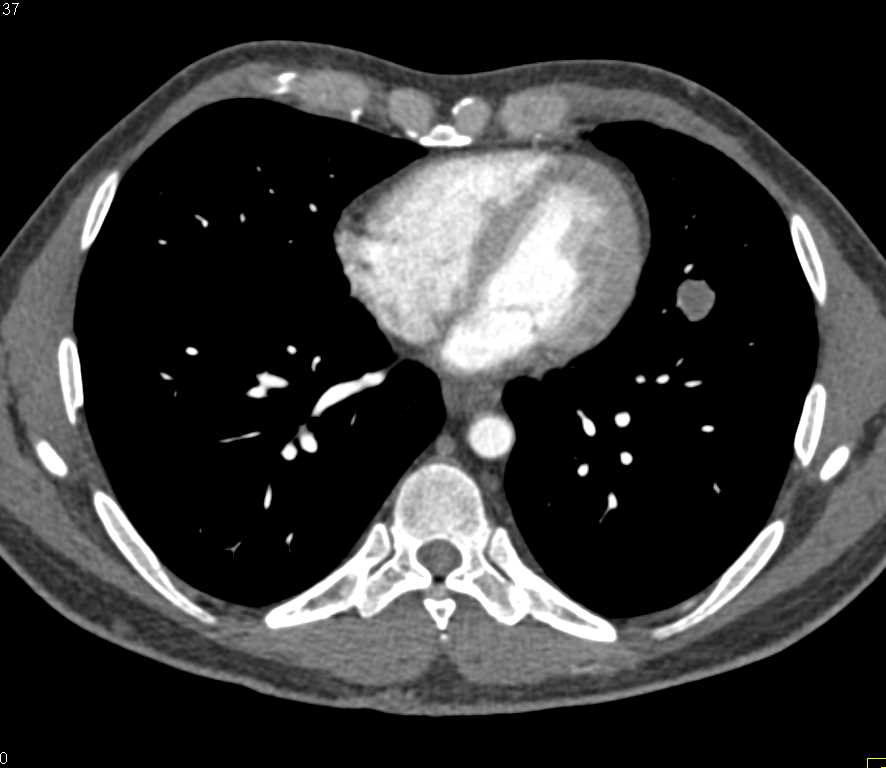 Lung Mass and Rib Metastases - Chest Case Studies - CTisus CT Scanning